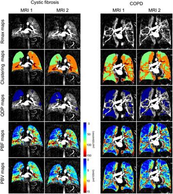 Unsupervised clustering algorithms improve the reproducibility of dynamic contrast-enhanced magnetic resonance imaging pulmonary perfusion quantification in muco-obstructive lung diseases